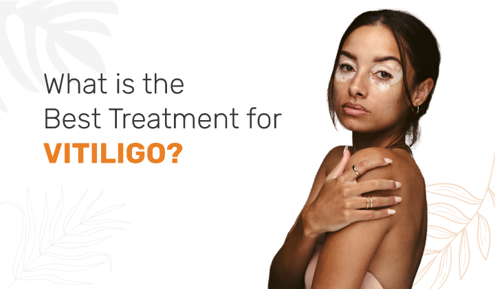 Vitiligo Treatment in Ahmedabad