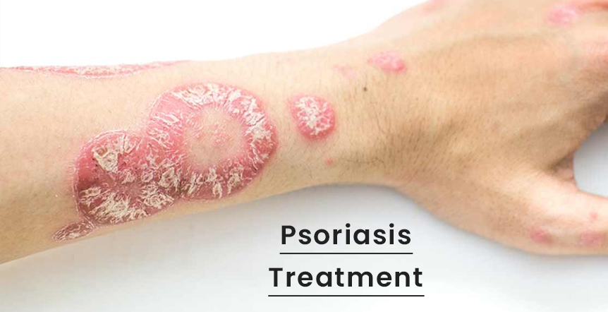 Psoriasis Treatment in Ahmedabad